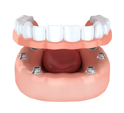 Optimum Oral Surgery & Dental Implants